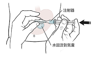 顯示胃造口管、氣囊和注射器的腹部正視圖。手拿著連接胃造口管的注射器,推動柱塞將氣球裝滿水。